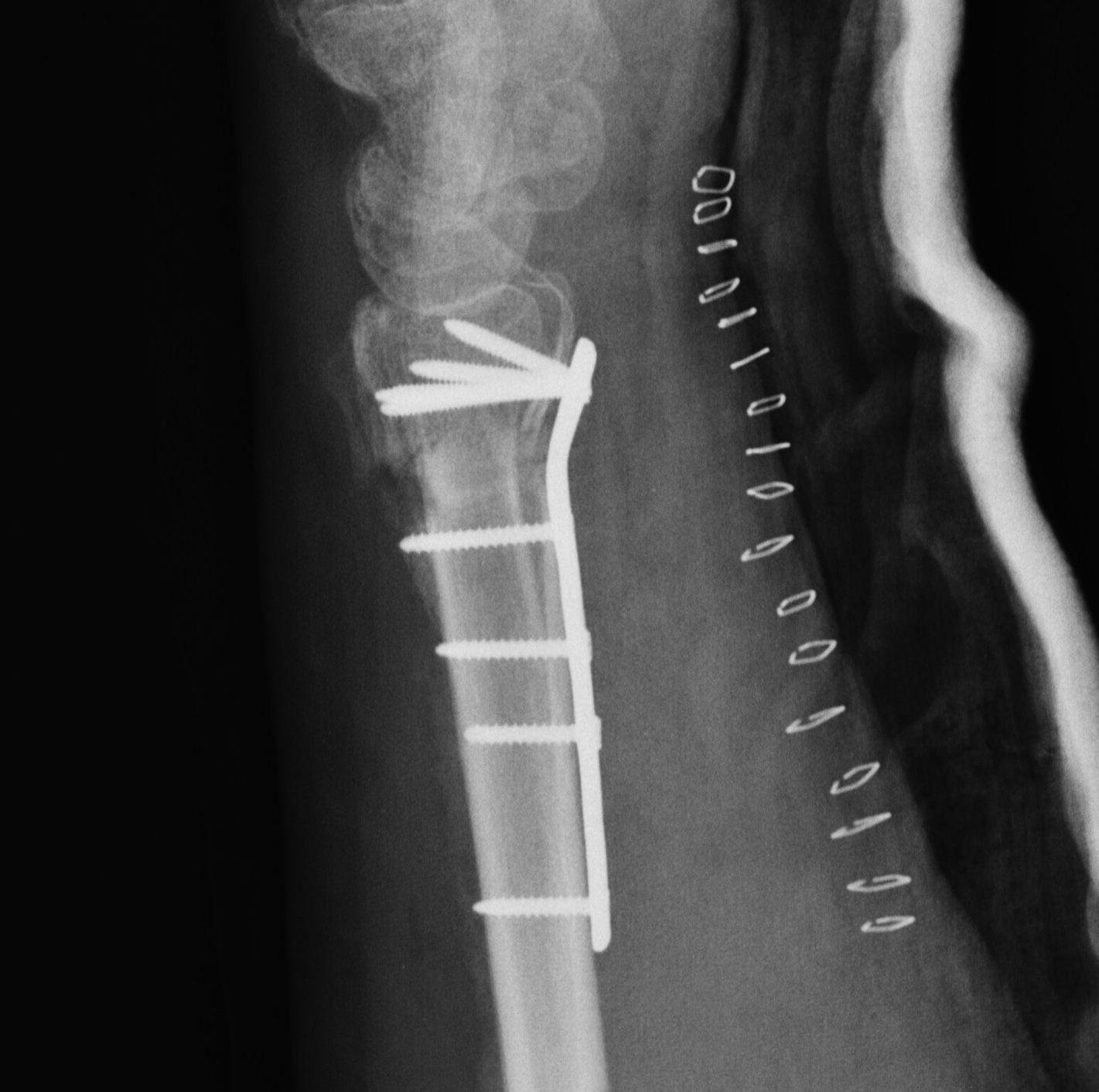 Radial Malunion Volar Opening Wedge Osteotomy Lateral